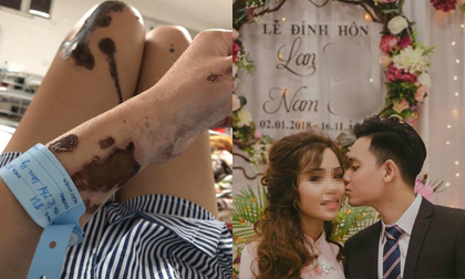 Cô gái xinh đẹp bị chồng sắp cưới là công an tạt axit: Đau đớn khi nhìn lại ảnh cũ