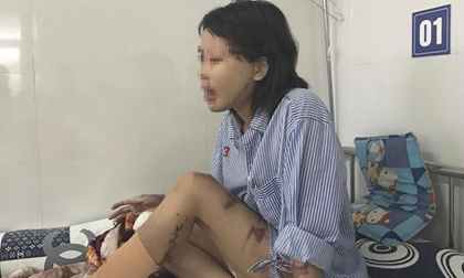 Vụ cô gái bị tạt axit: Bác sĩ ám ảnh vì một nửa khuôn mặt cháy đen