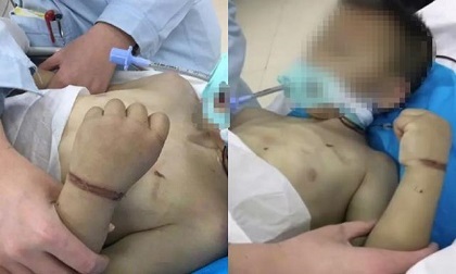 Bé 6 tuổi bị mẹ kế đánh tới nát sọ, gãy xương sườn, bố bỏ mặc vì sợ tốn tiền