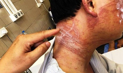 Đi du lịch biển, nam thanh niên hoại tử da vì bỏng sứa lửa