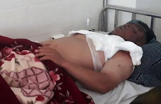 Bi hat nguyen noi lau dang soi vao mat khi du dam cuoi hinh anh 1 