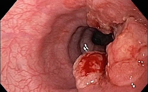 Đau lưng kéo dài, bệnh nhân bổ ngửa khi bác sĩ phát hiện ung thư thực quản - 1