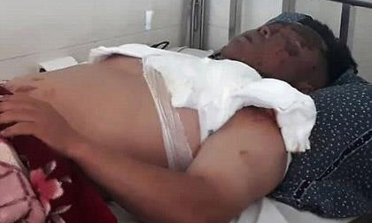 Bị hất nguyên nồi lẩu đang sôi vào mặt khi dự đám cưới