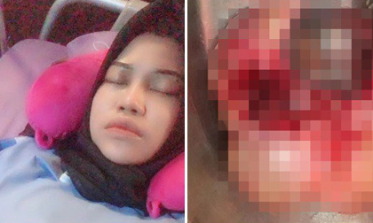 Cô gái có 2 khối u quái ở buồng trứng vì thích ăn loại thực phẩm nhiều người cũng mê