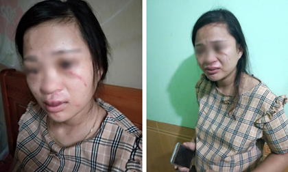 Mua đôi giày 135 ngàn, thai phụ 8 tháng bị mẹ chồng nói theo trai rồi xúi con đánh chảy máu mắt, bầm tím người