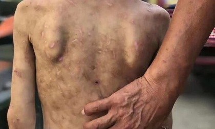 Bà dùng dây cáp đánh, dùng kìm bấm chằng chịt lên người cháu 7 tuổi