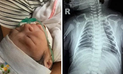 Bé sơ sinh vừa chào đời đã gãy xương đòn khiến cả gia đình choáng váng