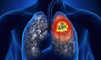 Đau xót 'thủ phạm gây ung thư' từ 4 người đàn ông khiến người phụ nữ mắc bệnh