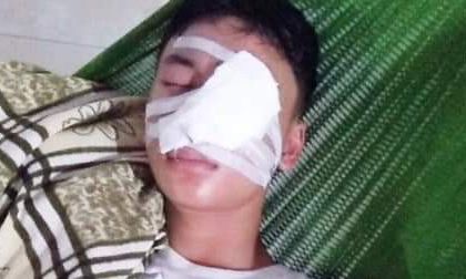 Nam định: Nam sinh lớp 10 bị nát mặt vì chó lạ tấn công