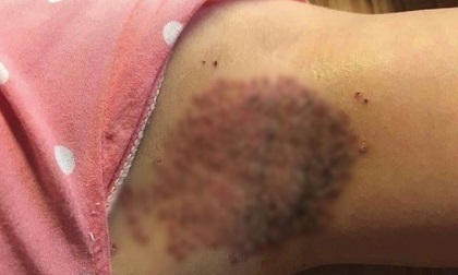 Cận cảnh ổ nách “nát tươm” sau khi đốt: Chuyên gia khẳng định trị hôi nách chưa bao giờ dễ dàng!