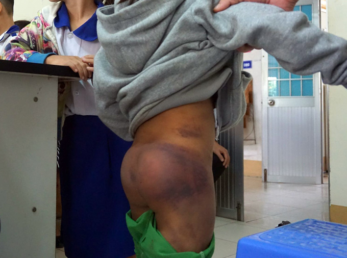 4 học sinh đến lớp với nhiều vết bầm trên người, nghi bị bạo hành 4 học sinh đến lớp với nhiều vết bầm trên người, nghi bị bạo hành