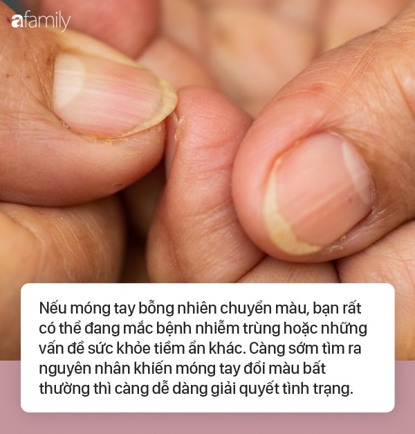 Móng tay vàng là dấu hiệu cảnh báo những vấn đề sức khỏe nghiêm trọng này