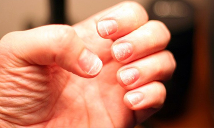 Móng tay vàng là dấu hiệu cảnh báo những vấn đề sức khỏe nghiêm trọng này