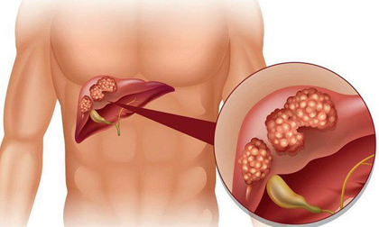 Nguyên nhân gây ra căn bệnh ung thư có tỷ lệ mắc mới nhiều nhất hiện nay tại Việt Nam