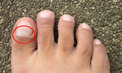 Thấy bàn chân có 'điềm báo' này, hãy cảnh giác vì thận đang gửi lời báo động nhiễm độc nặng