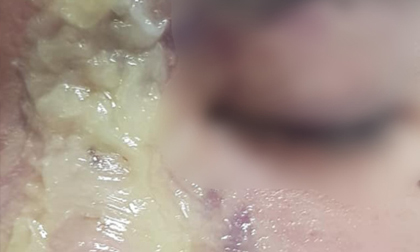 Sau khi tiêm filler nâng mũi giá 1,5 triệu đồng, thiếu nữ 15 tuổi mù mắt vĩnh viễn