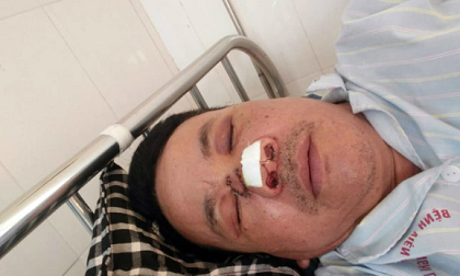Bị đuổi theo, 2 thanh niên trộm chó dùng chai thủy tinh ném gãy mũi trưởng công an xã