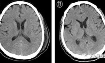 Lần đầu tiên phát hiện virus corona trong dịch não tủy của bệnh nhân