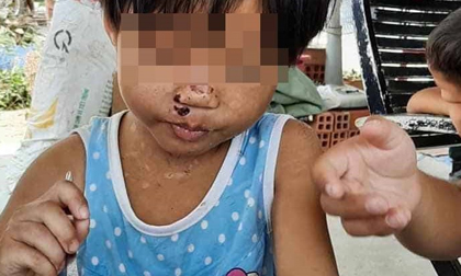 Thông tin mới nhất vụ bé gái 4 tuổi nghi bị cha dượng bạo hành dã man