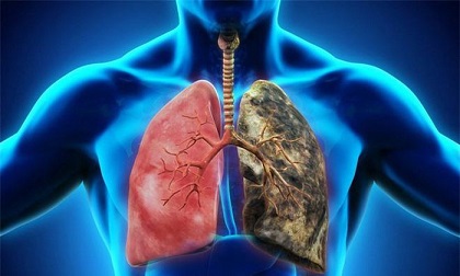 Những thực phẩm là 'sát thủ' hại phổi không kém gì khói độc