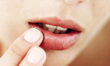Bong tróc môi có thể là dấu hiệu cảnh báo những vấn đề sức khỏe nghiêm trọng hơn bạn tưởng