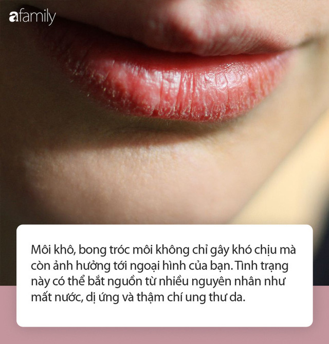 Bong tróc môi có thể là dấu hiệu cảnh báo những vấn đề sức khỏe nghiêm trọng hơn bạn tưởng - Ảnh 1. Bong tróc môi có thể là dấu hiệu cảnh báo những vấn đề sức khỏe nghiêm trọng hơn bạn tưởng - Ảnh 1.
