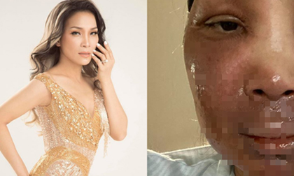 Hồng Ngọc đăng ảnh gương mặt bị bỏng sau vụ nổ nồi xông hơi