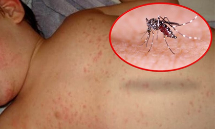 Bị sốt xuất huyết hãy ăn món này, khỏi bệnh cực nhanh và ngừa biến chứng rất tốt