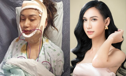Lynk Lee công khai quá trình phẫu thuật thẩm mỹ, vượt qua đau đớn để chạm đến giấc mơ sau 30 năm