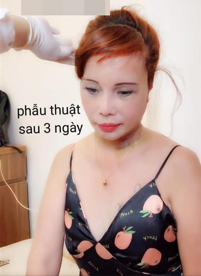 Diện mạo mới của cô dâu 62 tuổi ở Cao Bằng sau 3 ngày khiến dân mạng khiếp vía vì hậu phẫu căng da mặt - Ảnh 3.