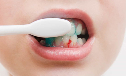 Chảy máu chân răng: Dấu hiệu cảnh báo nhiều bệnh nguy hiểm