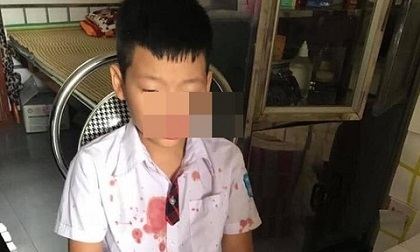 Học sinh lớp 1 bị cha của bạn đến tận trường đánh phải nhập viện