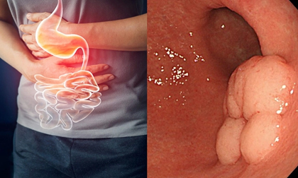 Những lưu ý cần biết để bảo vệ dạ dày của chính bạn và gia đình