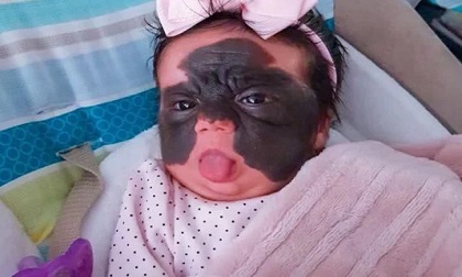 4 việc làm của mẹ bầu vô tình khiến trẻ sinh ra mang vết bớt xấu xí ở trên mặt