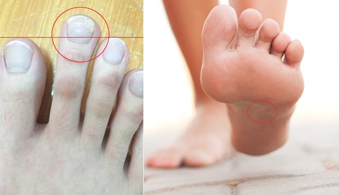 Bàn chân lõm sau gan bàn châm mềm tướng phát tài