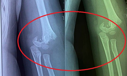 Hà Nội yêu cầu xác minh vụ trẻ mầm non bị ngã gãy tay tại trường