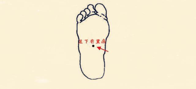 Nốt ruồi bàn chân giàu có