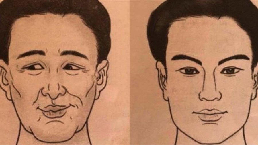 Tướng mũi gấp khúc nghèo khổ