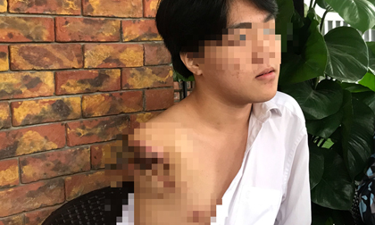 Nam sinh 16 tuổi bị máy tiện cuốn đứt lìa cánh tay trong giờ học thực hành
