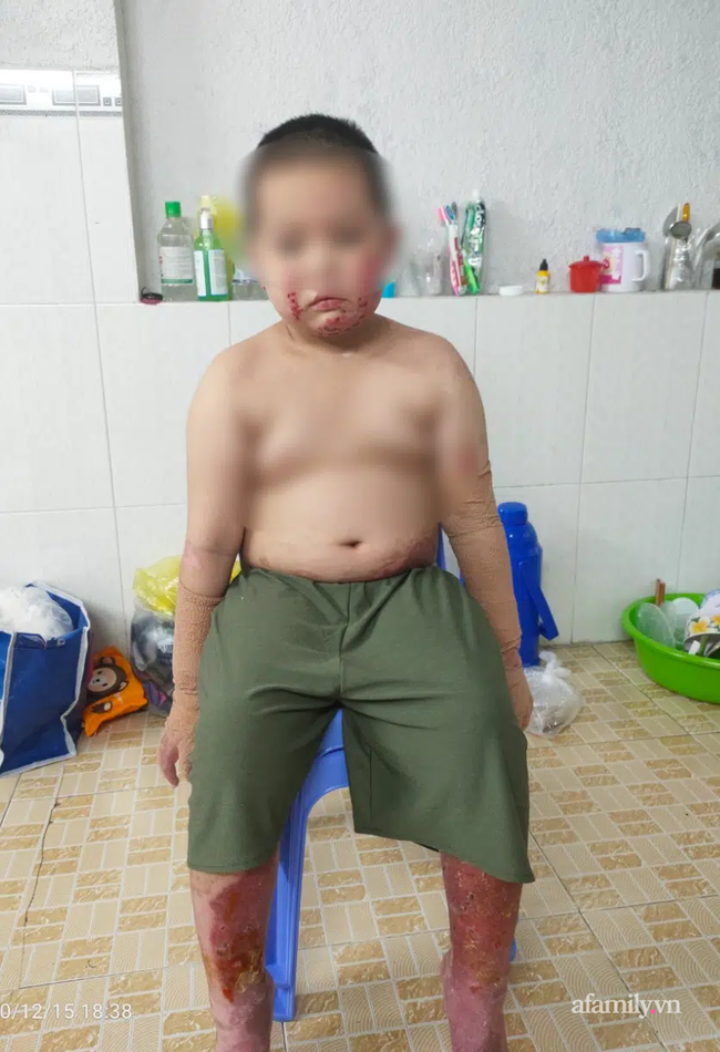 Vụ cha đóng cửa nhà châm lửa đốt khiến 2 con bỏng nặng, bản thân tử vong tại TP.HCM: Người mẹ bị sốc tâm lý, lúc tỉnh lúc mê Vụ cha đóng cửa nhà châm lửa đốt khiến 2 con bỏng nặng, bản thân tử vong tại TP.HCM: Người mẹ bị sốc tâm lý, lúc tỉnh lúc mê
