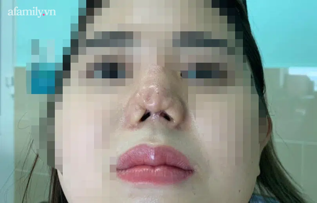TP.HCM: Cô gái 22 tuổi suy sụp tinh thần, uống 30 viên thuốc tự tử vì bị bác sĩ thẩm mỹ 'dỏm' phá nát mũi - 2