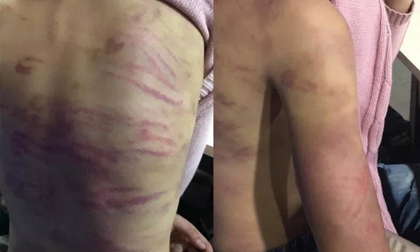 Điều tra vụ thiếu nữ 15 tuổi bị mẹ đẻ cùng “người tình” bạo hành dã man