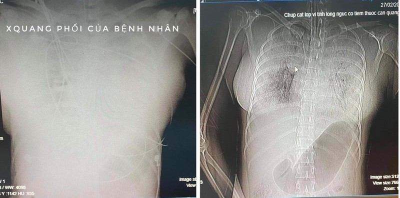 TP.HCM: Người phụ nữ 32 tuổi tử vong bất thường sau 1 tuần tiêm filler nâng ngực