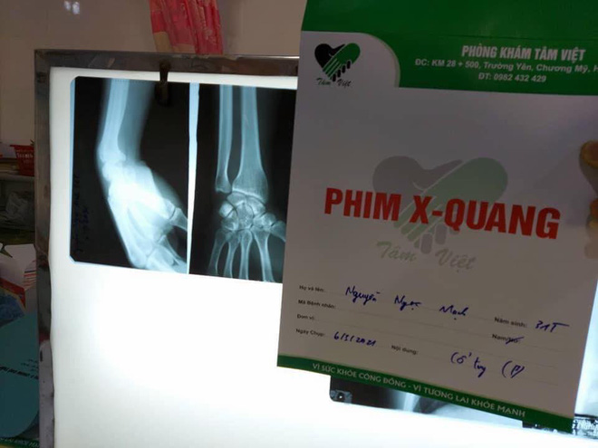 Người hùng cứu bé 3 tuổi rơi từ tầng 12 chung cư ở Hà Nội bị rạn xương tay, phải tạm nghỉ lái xe - Ảnh 2.