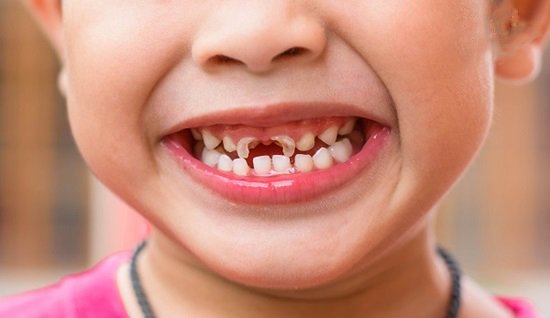 Sâu răng làm giảm chức năng nhai