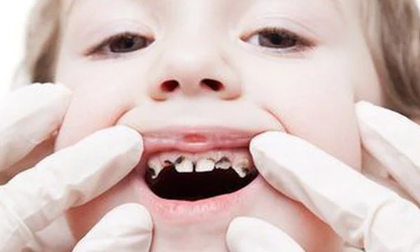 Nguy hại khôn lường từ việc không điều trị răng sâu cho trẻ