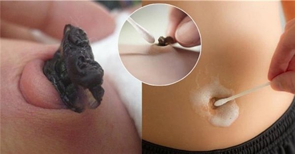 Rốn không nên làm sạch sẽ quá