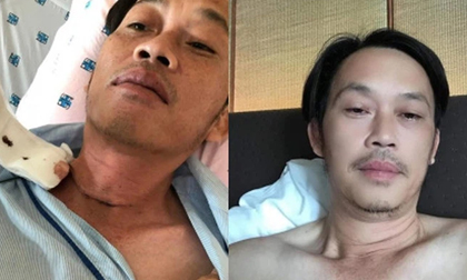 Căn bệnh ung thư mà Nghệ sĩ Hoài Linh mắc có nguy hiểm không?