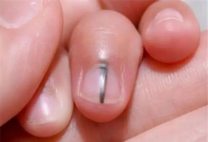 Bàn tay có vệt đen chạy dọc