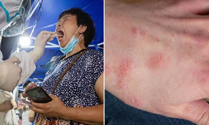 Đừng chỉ theo dõi sốt, ho: 8 triệu chứng phát ban có thể là dấu hiệu mắc Covid-19